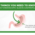 4 Things You Need To Know About Endoscopic Sleeve Gastroplasty