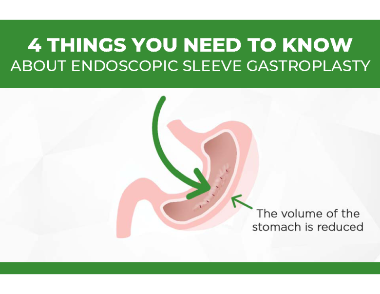 4 Things You Need To Know About Endoscopic Sleeve Gastroplasty