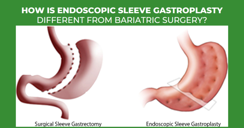How is Endoscopic Sleeve Gastroplasty (ESG) different from Bariatric Surgery
